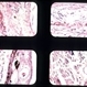 Infectious Retinitis